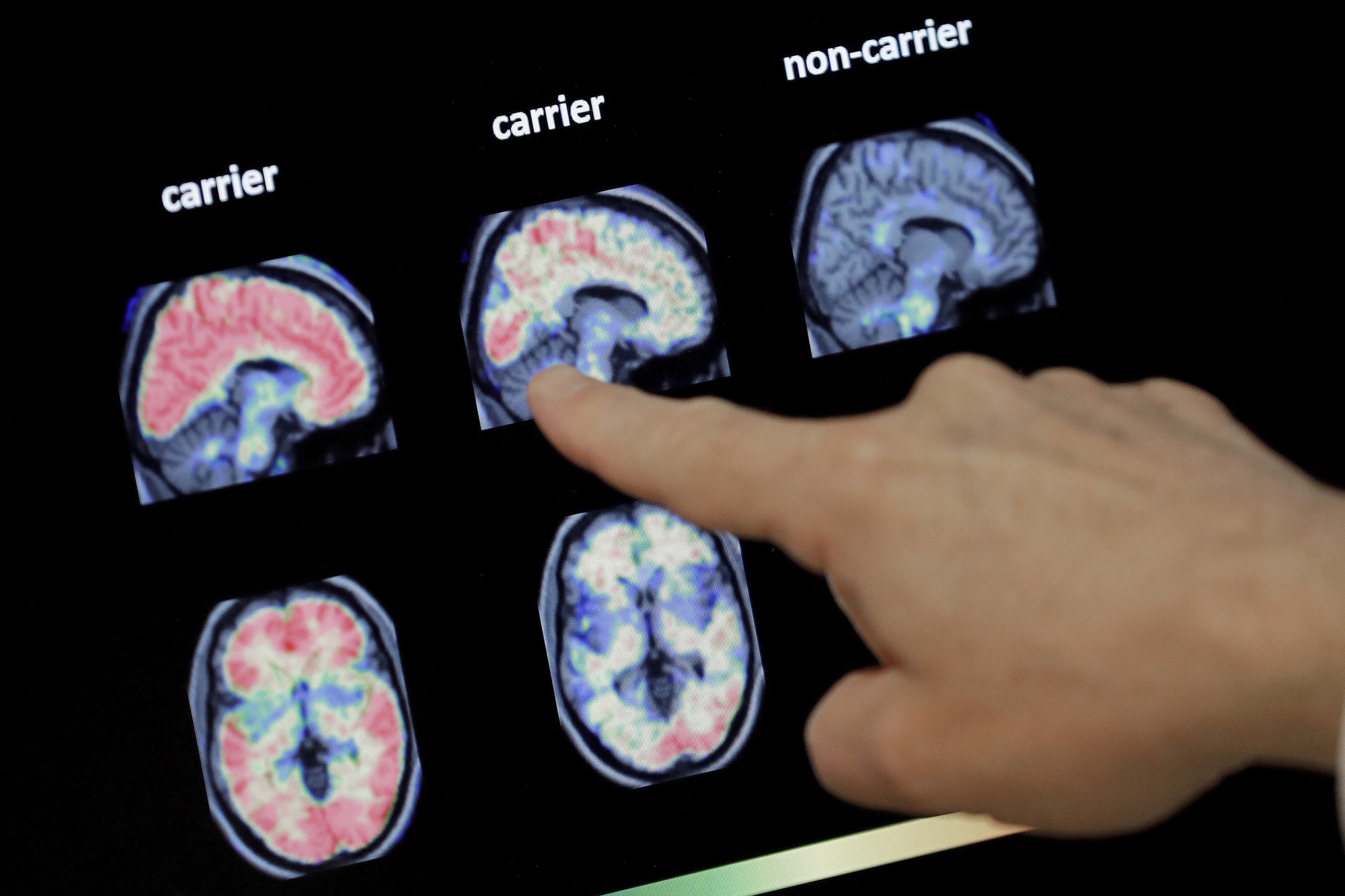 FILE - In this Aug. 14, 2018 file photo, a doctor looks at a PET brain scan at the Banner Alzheimers Institute in Phoenix. Two experimental drugs failed to prevent or slow mental decline in a study of people who are virtually destined to develop Alzheimer's disease at a relatively young age because of rare gene flaws. The results announced Monday, Feb. 10, 2020, are another disappointment for the approach that scientists have focused on for many years -- trying to remove a harmful protein that builds up in the brains of people with the disease. (AP Photo/Matt York, File)