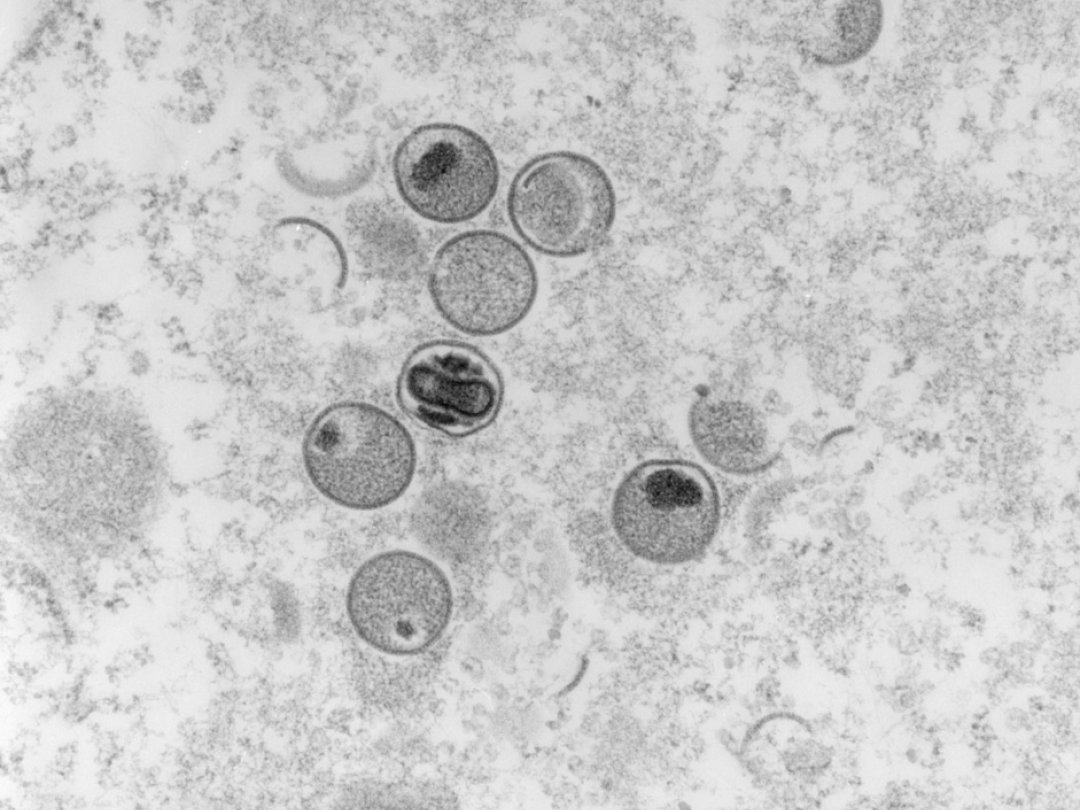 La variole du singe est une cousine moins dangereuse de la variole, éradiquée depuis une quarantaine d'années.