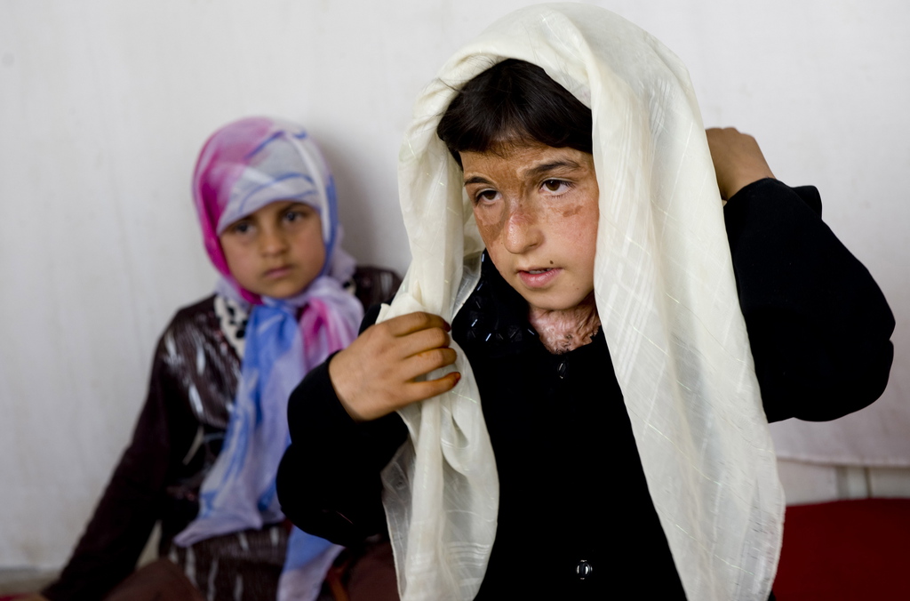 epa02135040 Afghan girl Fareeba (one name available), who set herself on fire in 2009, shows her burn scars as her sister (L) looks on at their home in Herat, western Afghanistan on 10 March 2010. Forced marriages and a lack of education contribute to a recent spate of suicide attempts among women in Afghanistan, reports said. Afghan women are in a subordinate position in society, where conservative Islamic laws and traditions dictate what a woman is allowed to do in a male dominated world. Forced marriages, domestic violence, poverty and lack of access to education are said to be some of the main reasons for self immolation. During the five-year rule of the Taliban militia, women were not allowed to work or study. They could not leave their homes without a male escort and were forced to wear the all-encompassing burqa. Since the fall of the Taliban in late 2001, women have once again been given the right to study and work. But rights activists say women in many parts of Afghanistan, including Herat, still face repression and harassment by the local authorities.  EPA/HOSSEIN FATEMI