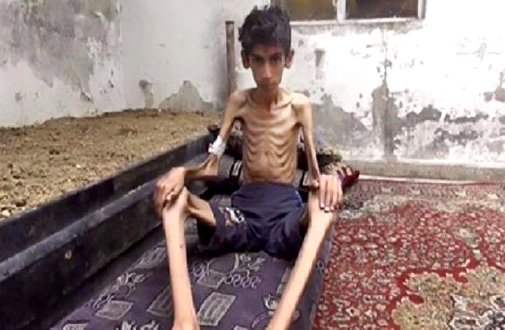 D'atroces photos montrant des enfants affamés ont alerté l'opinion publique sur le sort de Madaya.