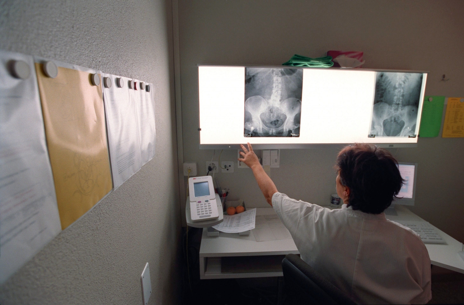 Eine Aerztin der urologischen Abteilung des Inselspitals Bern betrachtet an der Leuchttafel Roentgenbilder eines Patienten mit Nierensteinen, aufgenommen am 10. November 2004.  (KEYSTONE/Gaetan Bally)  === , , EDITORIAL USE ONLY ===  : FILM] SCHWEIZ INSELSPITAL BEHANDLUNG