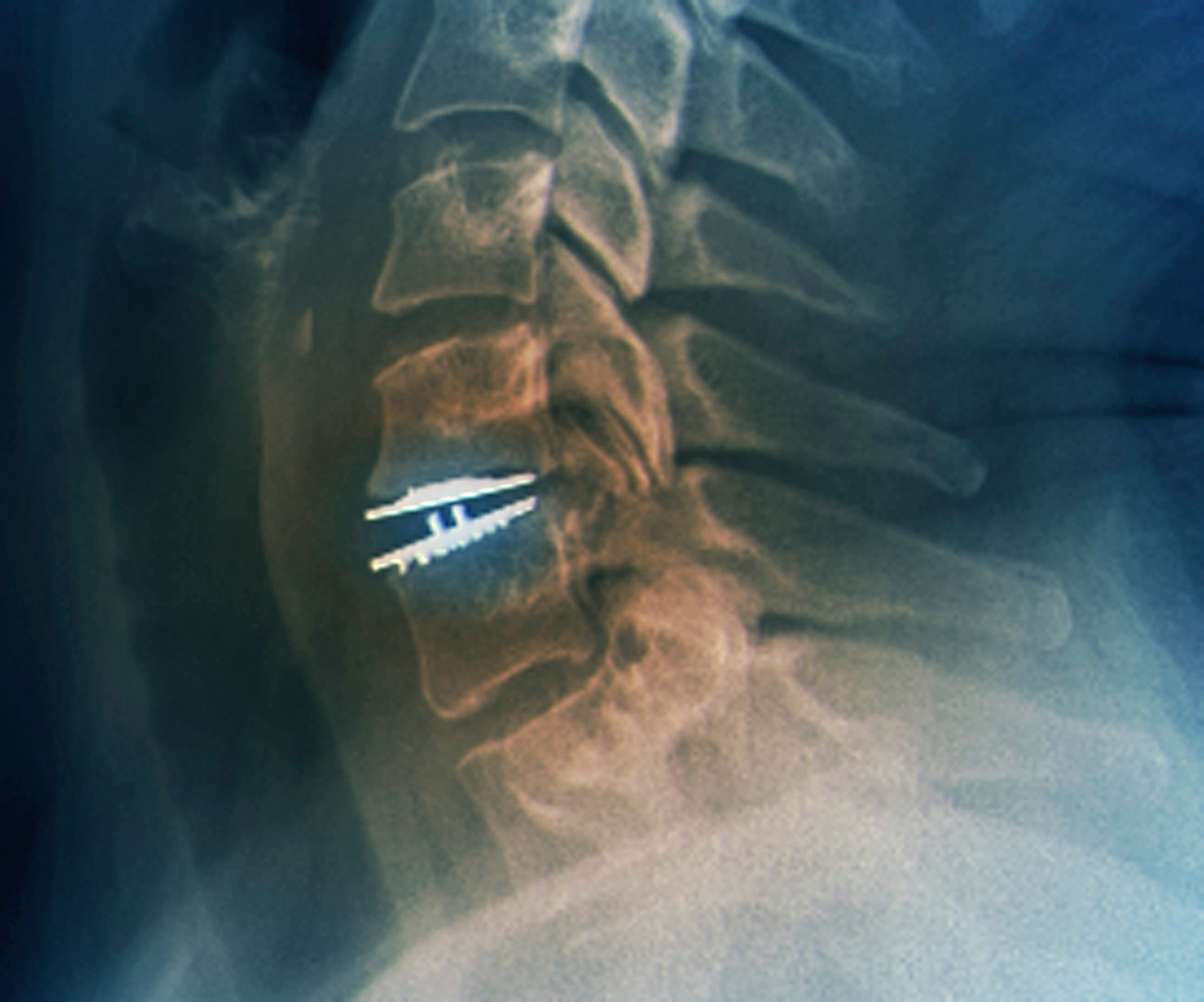 Cervical intervertebral disc implant. Coloured lateral X-ray of the cervical (neck) spine of a 38-year-old woman, showing the presence of an implant (white) following an operation to repair a slipped (herniated) intervertebral disc. This was a herniation of the disc between the C5 and C6 vertebrae, which was treated with the implantation of a Mobi-C artificial disc. Slipped discs can lead to the herniated tissue pressing on the spinal cord, causing severe pain and other neurological symptoms. (KEYSTONE/SCIENCE PHOTO LIBRARY/ZEPHYR/SCIENCE PHOTO LIBRARY) CERVICAL INTERVERTEBRAL DISC IMPLANT, X-RAY