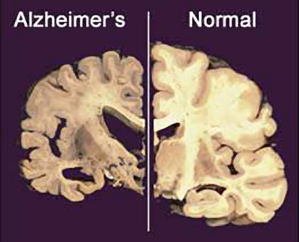 FILE - This undated file image provided by Merck & Co., shows a cross section of a normal brain, right, and one of a brain damaged by advanced Alzheimer's disease. A dramatic shift is beginning in the disappointing struggle to find something to slow the damage of Alzheimer's disease: The first U.S. experiments with "brain pacemakers" for Alzheimer's are getting under way. Scientists are looking beyond drugs to implants in the hunt for much-needed new treatments. (AP Photo/Merck & Co., File)